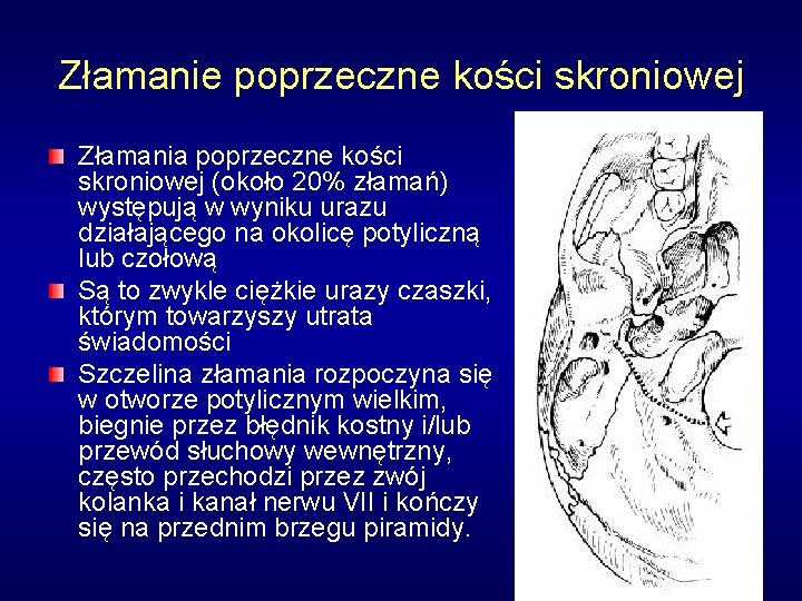 Złamanie poprzeczne kości skroniowej Złamania poprzeczne kości skroniowej (około 20% złamań) występują w wyniku