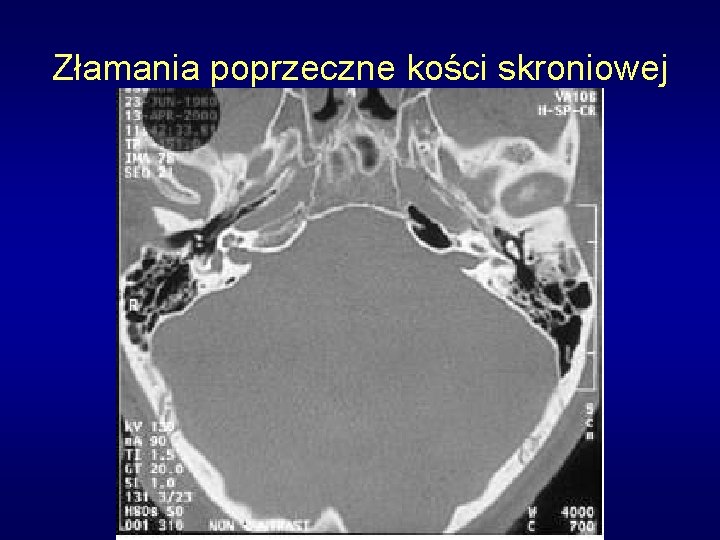 Złamania poprzeczne kości skroniowej 