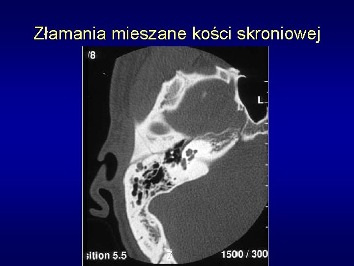 Złamania mieszane kości skroniowej 