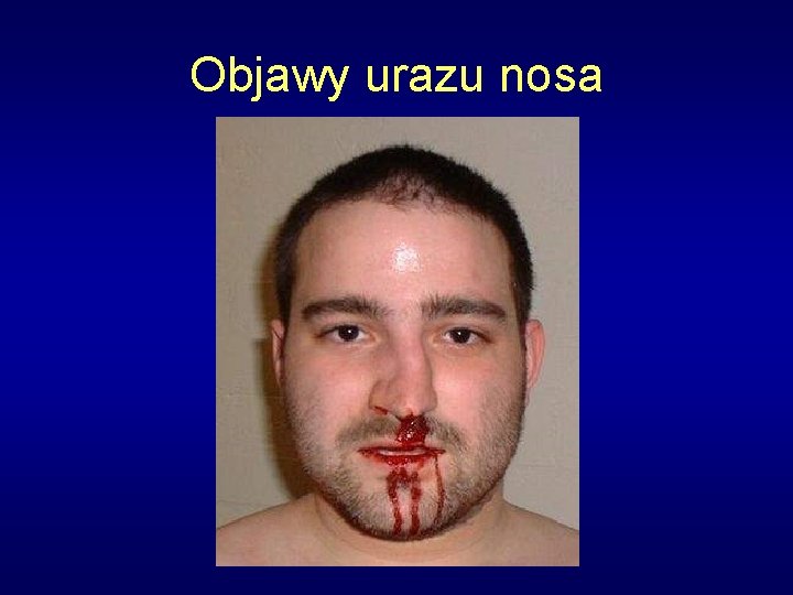 Objawy urazu nosa 