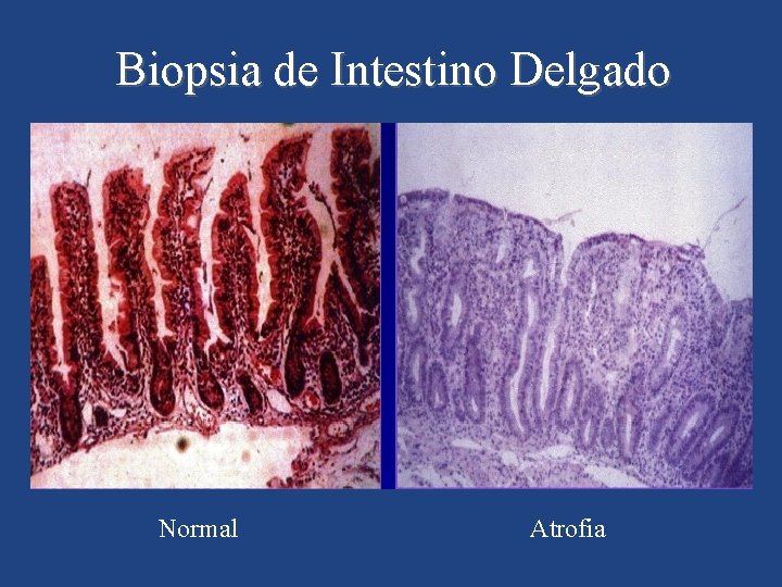 Biopsia de Intestino Delgado Normal Atrofia 