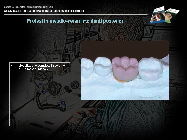Protesi in metallo-ceramica: denti posteriori • Modellazione completa in cera del primo molare inferiore.