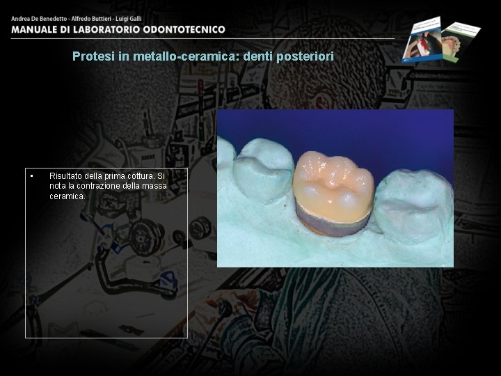 Protesi in metallo-ceramica: denti posteriori • Risultato della prima cottura. Si nota la contrazione