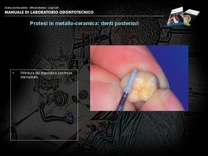 Protesi in metallo-ceramica: denti posteriori • Rifinitura del dispositivo con frese diamantate. 26 