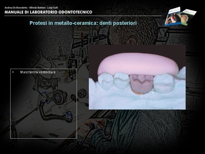 Protesi in metallo-ceramica: denti posteriori • Mascherina vestibolare. 3 