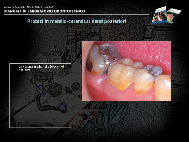Protesi in metallo-ceramica: denti posteriori • La corona in situ nella bocca del paziente.