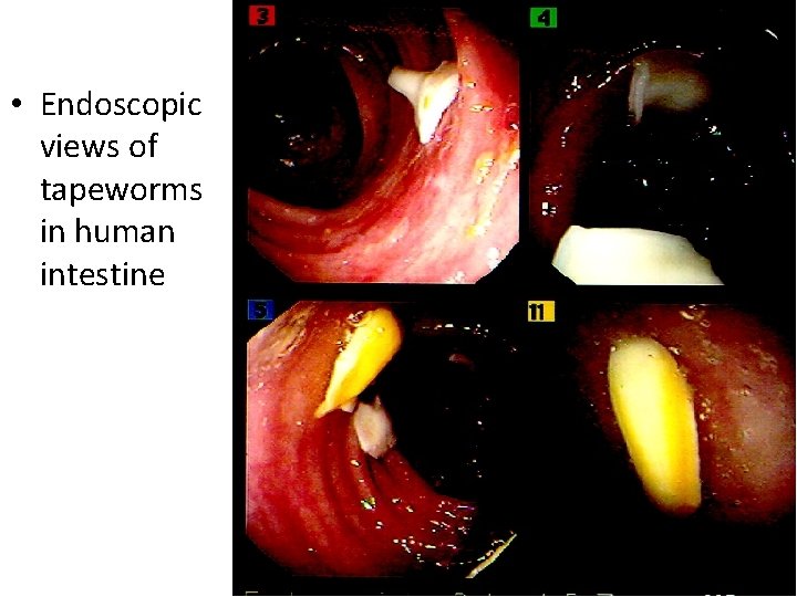  • Endoscopic views of tapeworms in human intestine 