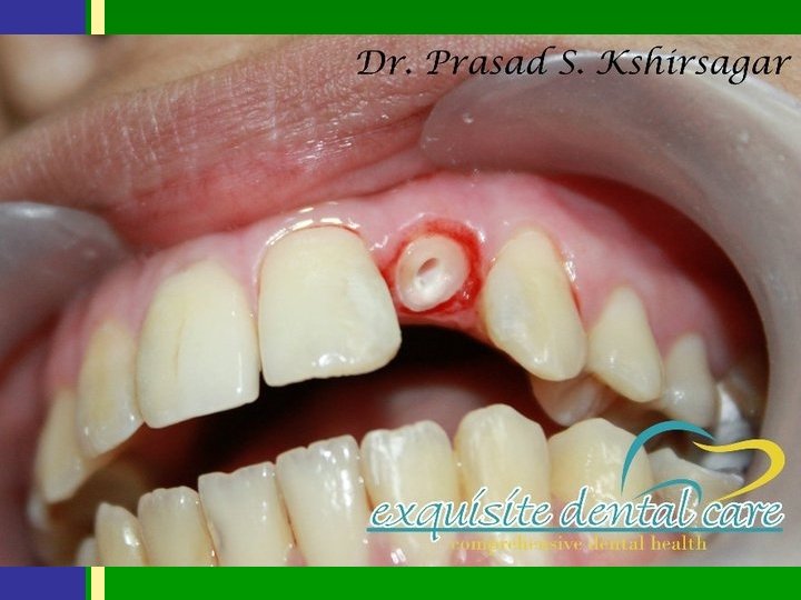 TERAPIJSKI POSTUPCI U PARODONTOLOGIJI PARODONTALNA KIRURGIJA • • • 1) 2) 3) 4) 5)