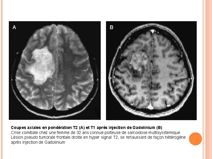 A B Coupes axiales en pondération T 2 (A) et T 1 après injection