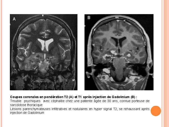 A B Coupes coronales en pondération T 2 (A) et T 1 après injection