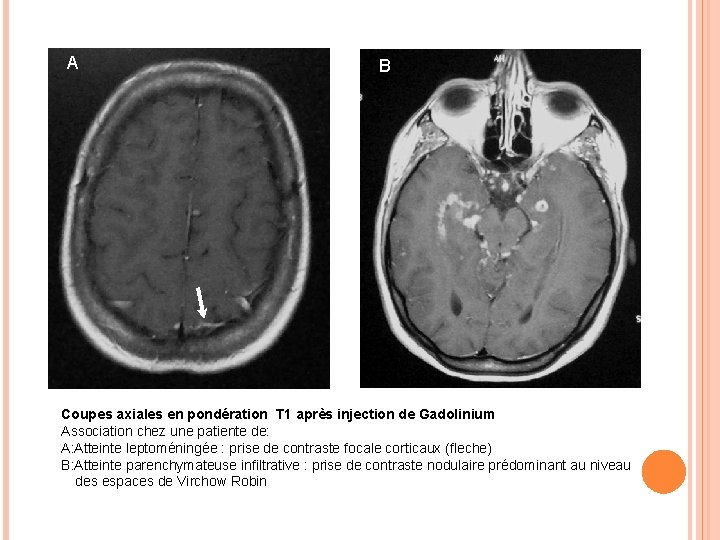 A B Coupes axiales en pondération T 1 après injection de Gadolinium Association chez