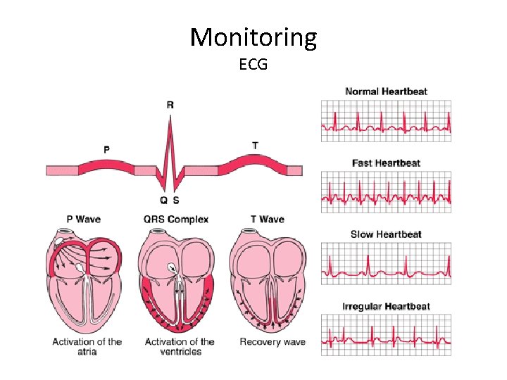 Monitoring ECG 