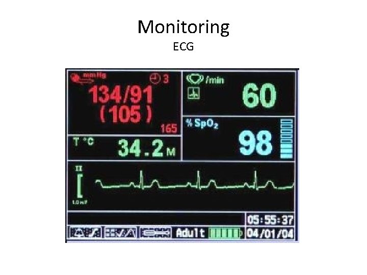 Monitoring ECG 