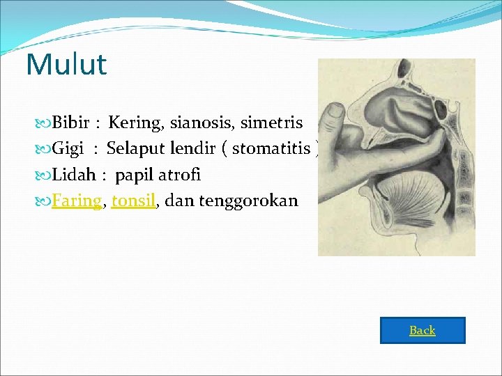 Mulut Bibir : Kering, sianosis, simetris Gigi : Selaput lendir ( stomatitis ) Lidah