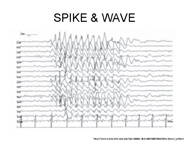 SPIKE & WAVE http: //www. scielo. br/scielo. php? pid=S 0004 -282 X 200700036&script=sci_arttext 