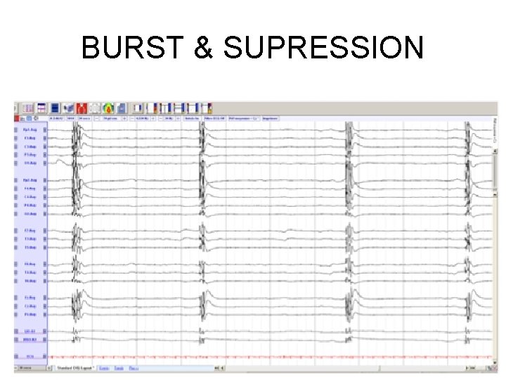 BURST & SUPRESSION 