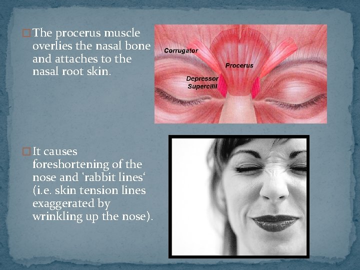 � The procerus muscle overlies the nasal bone and attaches to the nasal root