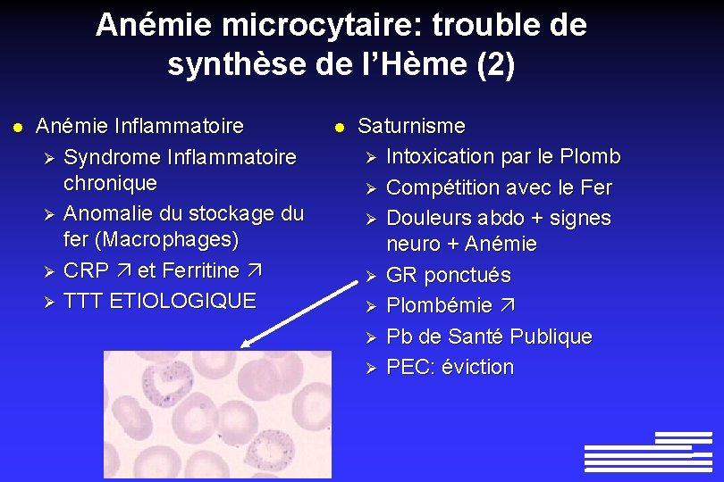 Anémie microcytaire: trouble de synthèse de l’Hème (2) l Anémie Inflammatoire Ø Syndrome Inflammatoire