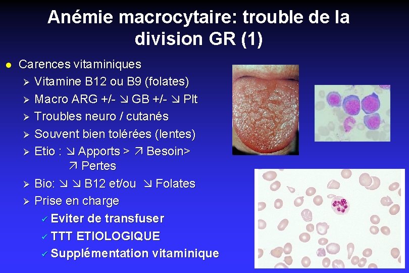 Anémie macrocytaire: trouble de la division GR (1) l Carences vitaminiques Ø Vitamine B