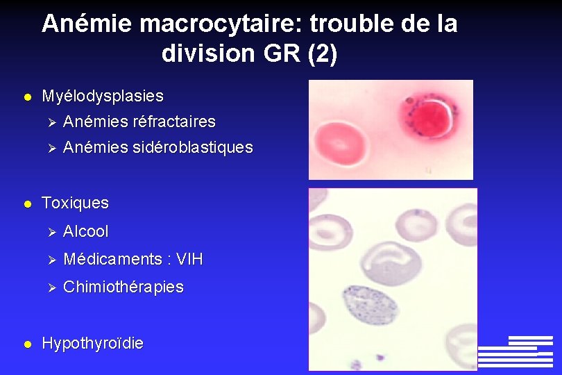 Anémie macrocytaire: trouble de la division GR (2) l Myélodysplasies Ø Anémies réfractaires Ø