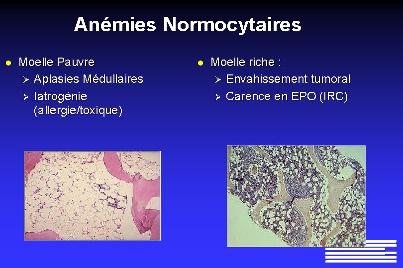 Anémies Normocytaires l Moelle Pauvre Ø Aplasies Médullaires Ø Iatrogénie (allergie/toxique) l Moelle riche