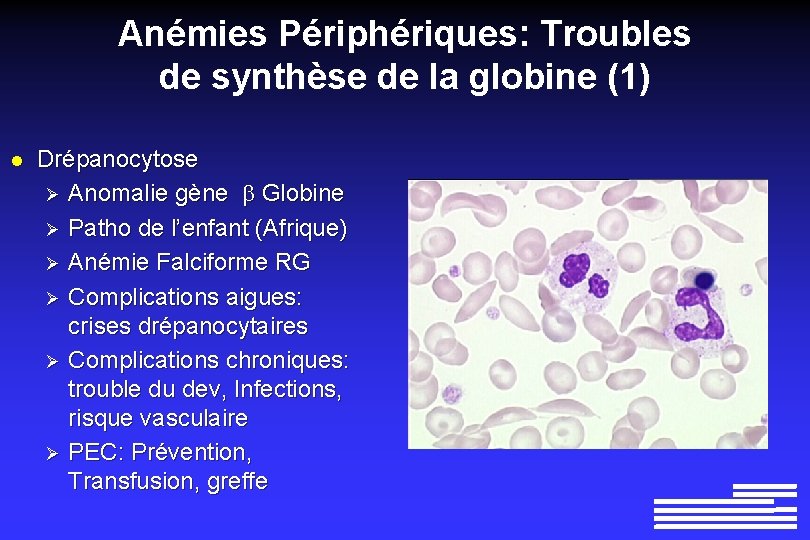 Anémies Périphériques: Troubles de synthèse de la globine (1) l Drépanocytose Ø Anomalie gène