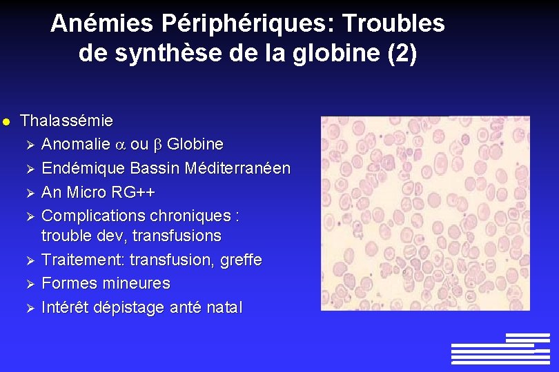 Anémies Périphériques: Troubles de synthèse de la globine (2) l Thalassémie Ø Anomalie ou