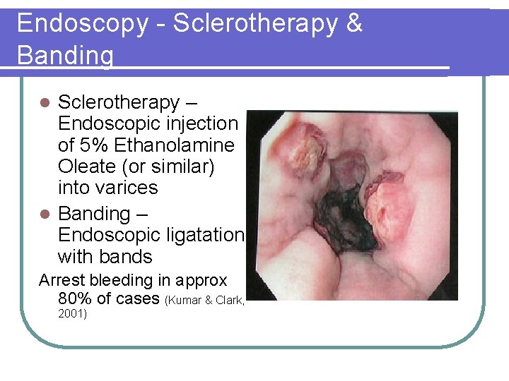 Endoscopy - Sclerotherapy & Banding Sclerotherapy – Endoscopic injection of 5% Ethanolamine Oleate (or