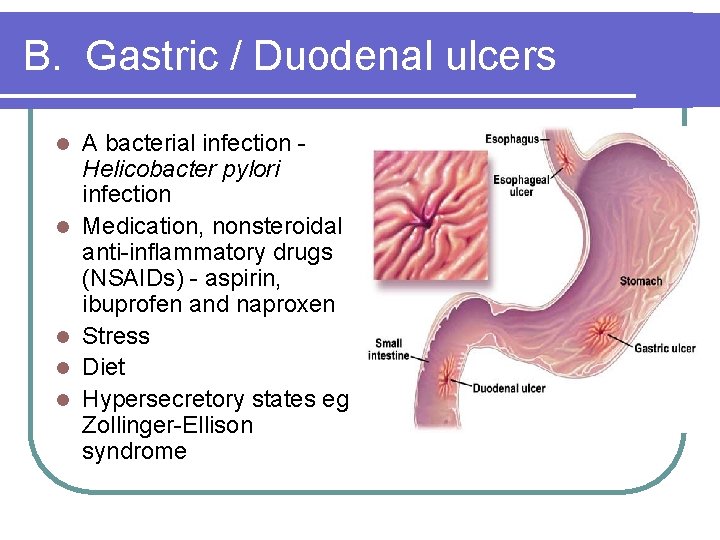 B. Gastric / Duodenal ulcers l l l A bacterial infection Helicobacter pylori infection
