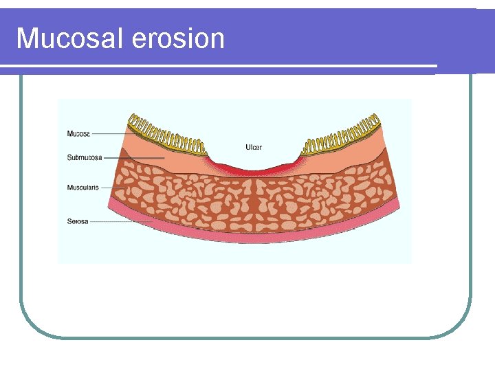 Mucosal erosion 