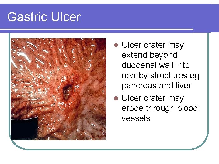 Gastric Ulcer crater may extend beyond duodenal wall into nearby structures eg pancreas and