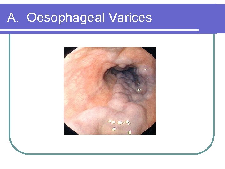 A. Oesophageal Varices 