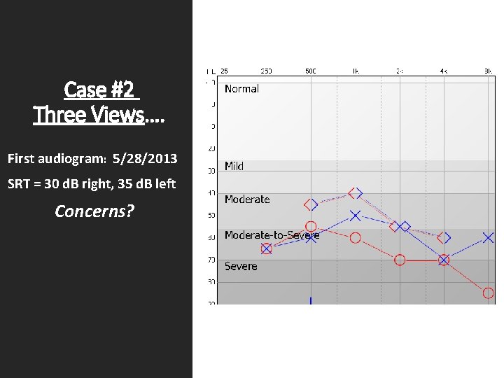 Case #2 Three Views…. First audiogram: 5/28/2013 SRT = 30 d. B right, 35