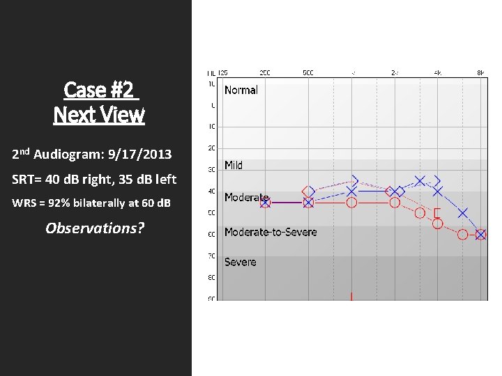 Case #2 Next View 2 nd Audiogram: 9/17/2013 SRT= 40 d. B right, 35