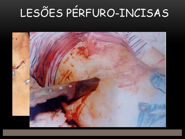 LESÕES PÉRFURO-INCISAS 