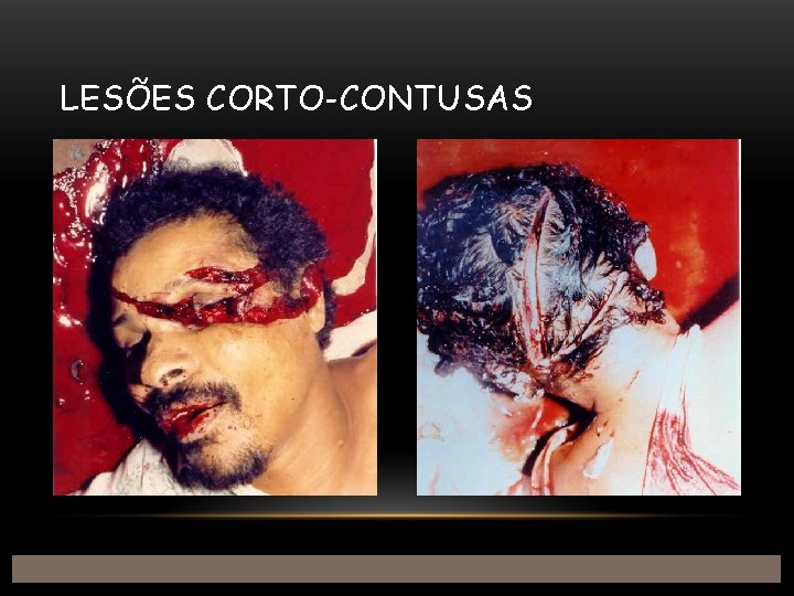 LESÕES CORTO-CONTUSAS 