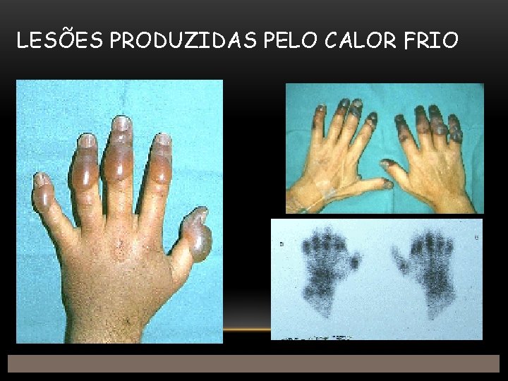 LESÕES PRODUZIDAS PELO CALOR FRIO 
