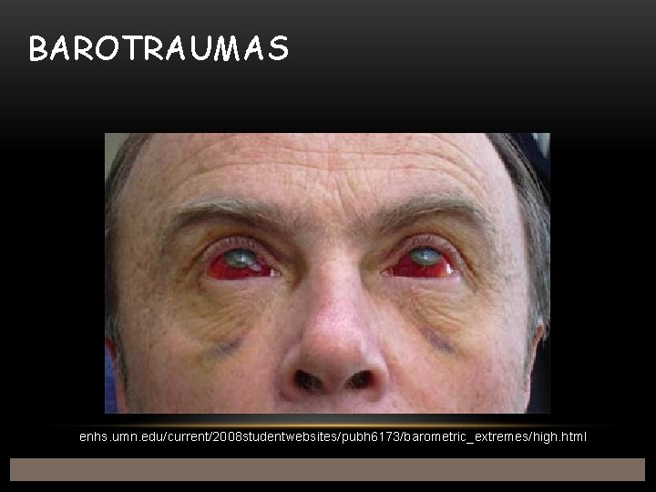 BAROTRAUMAS enhs. umn. edu/current/2008 studentwebsites/pubh 6173/barometric_extremes/high. html 