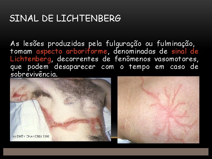 SINAL DE LICHTENBERG As lesões produzidas pela fulguração ou fulminação, tomam aspecto arboriforme, denominadas