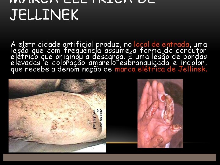 MARCA ELÉTRICA DE JELLINEK A eletricidade artificial produz, no local de entrada, uma lesão