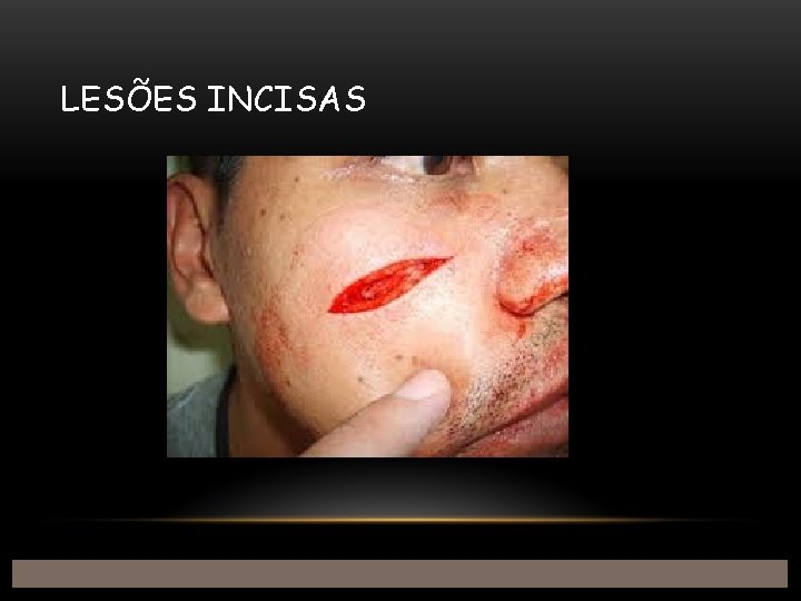 LESÕES INCISAS 
