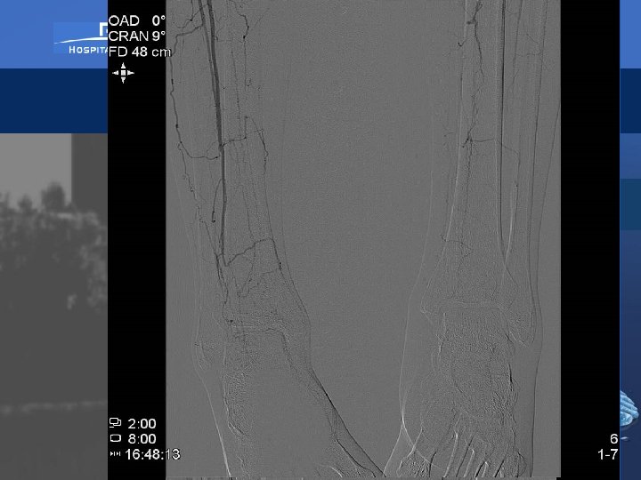 Arteriografia 