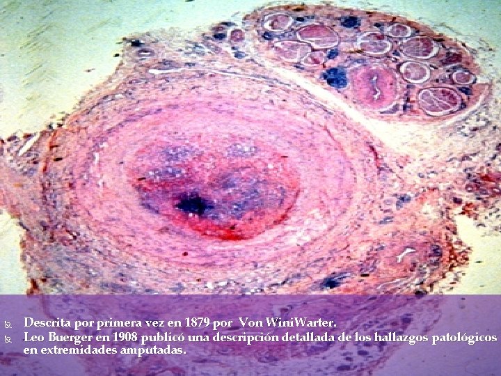 Enfermedad de Buerger Descrita por primera vez en 1879 por Von Wini. Warter. Leo