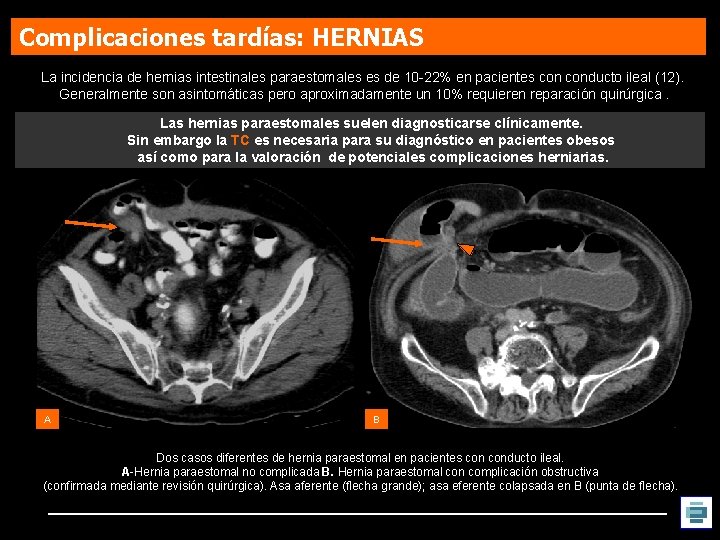 Complicaciones tardías: HERNIAS La incidencia de hernias intestinales paraestomales es de 10 -22% en