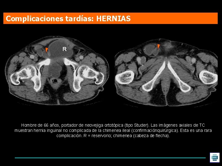 Complicaciones tardías: HERNIAS R Hombre de 66 años, portador de neovejiga ortotópica (tipo Studer).