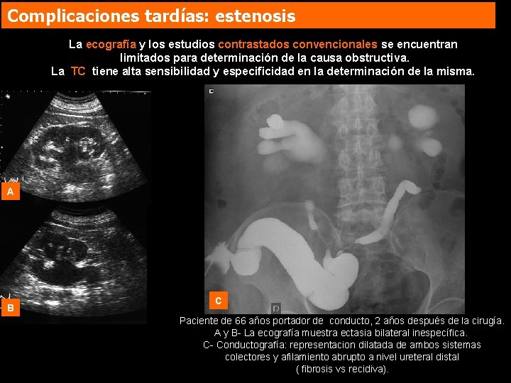 Complicaciones tardías: estenosis La ecografía y los estudios contrastados convencionales se encuentran limitados para