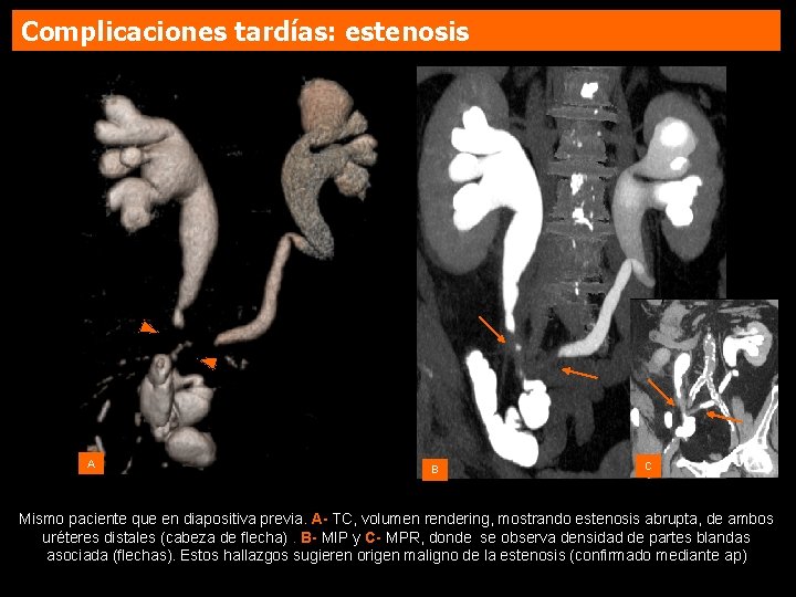 Complicaciones tardías: estenosis A B C Mismo paciente que en diapositiva previa. A- TC,