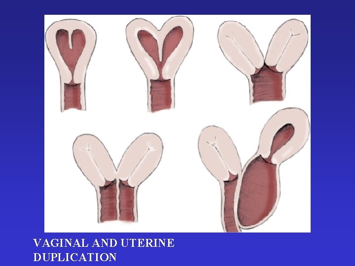 VAGINAL AND UTERINE DUPLICATION 