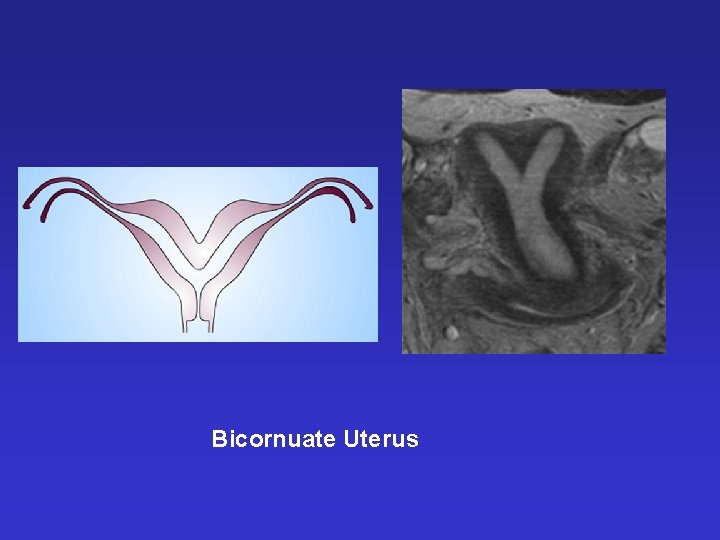 Bicornuate Uterus 