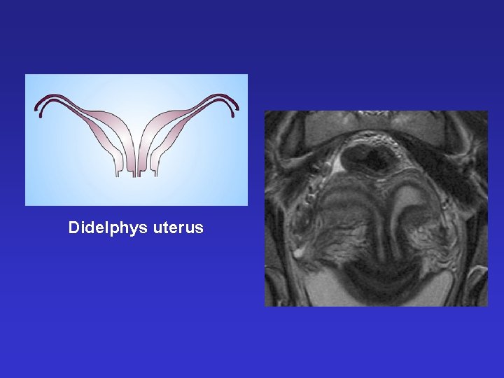 Didelphys uterus 